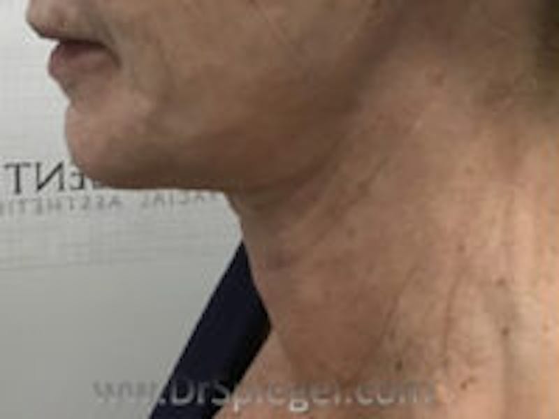 Neck Lift Before & After Gallery - Patient 157140082 - Image 2