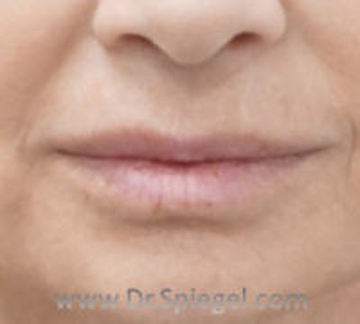 Lip Lift Before & After Gallery - Patient 157140087 - Image 1