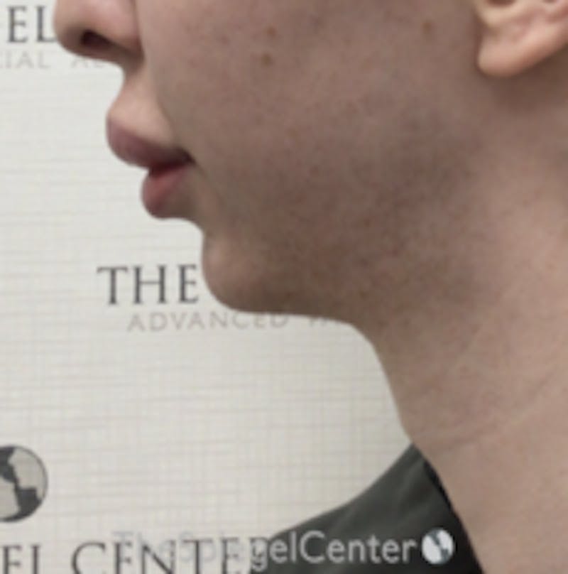Trachea Shave Before & After Gallery - Patient 157140086 - Image 2