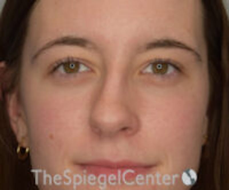 Rhinoplasty Before & After Gallery - Patient 157140093 - Image 3