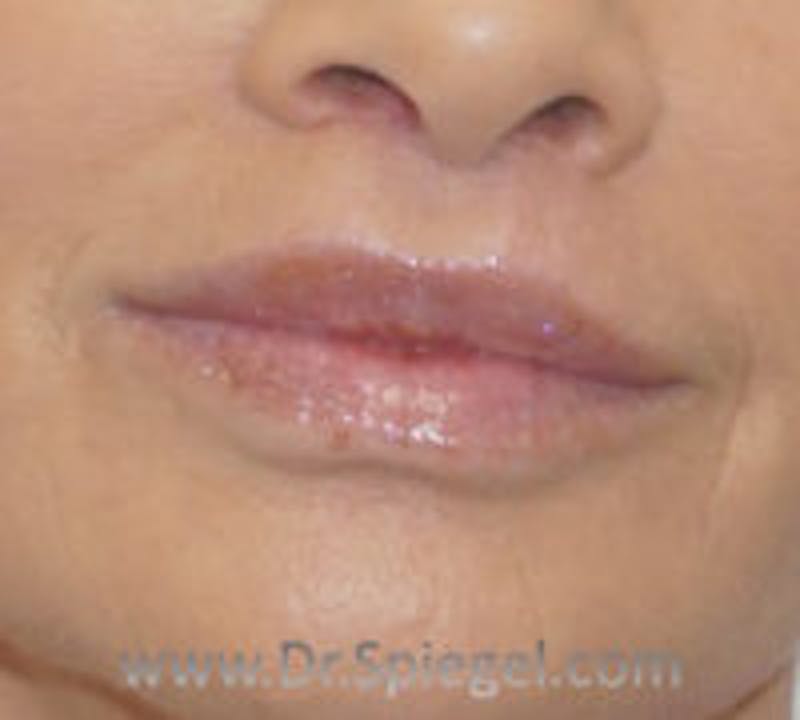 Lip Augmentation / Lip Implant / Lip Lift Before & After Gallery - Patient 157140087 - Image 2