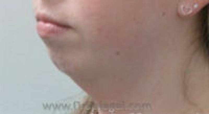 Neck Lift Before & After Gallery - Patient 157140088 - Image 1