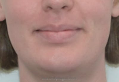 Mandible Contouring Before & After Gallery - Patient 157140091 - Image 1
