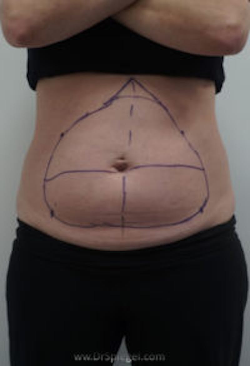 Bodytite Before & After Gallery - Patient 157140101 - Image 1