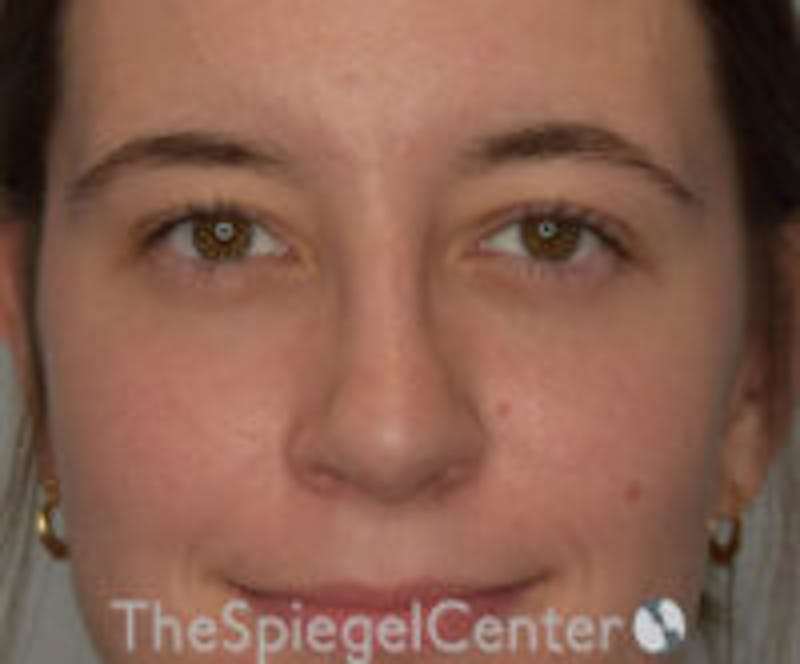 Rhinoplasty Before & After Gallery - Patient 157140093 - Image 4
