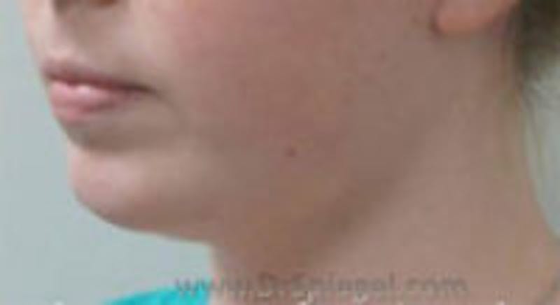 Neck Lift Before & After Gallery - Patient 157140088 - Image 2