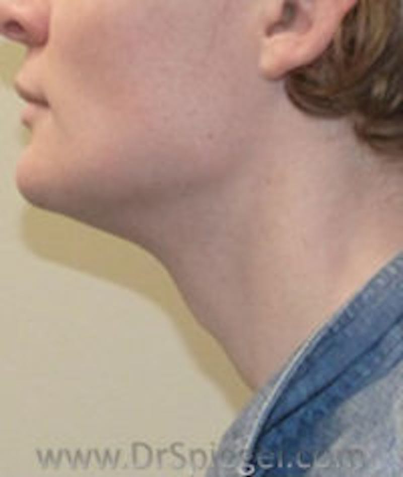 Trachea Shave Before & After Gallery - Patient 157140094 - Image 1