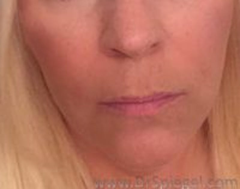 Lip Lift Before & After Gallery - Patient 157140095 - Image 1