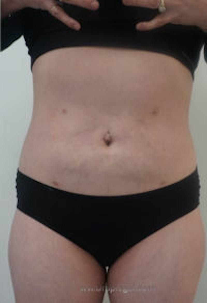 Bodytite Before & After Gallery - Patient 157140101 - Image 2