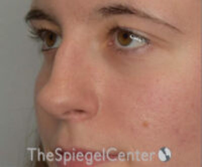 Rhinoplasty Before & After Gallery - Patient 157140093 - Image 1
