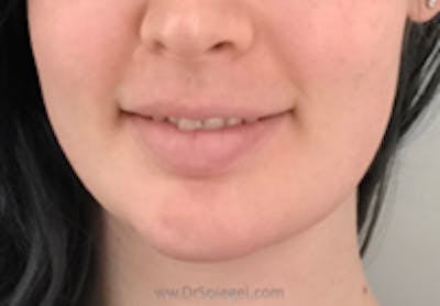 Mandible Contouring Before & After Gallery - Patient 157140091 - Image 2