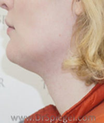 Trachea Shave Before & After Gallery - Patient 157140094 - Image 2