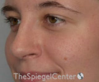 Rhinoplasty Before & After Gallery - Patient 157140093 - Image 2