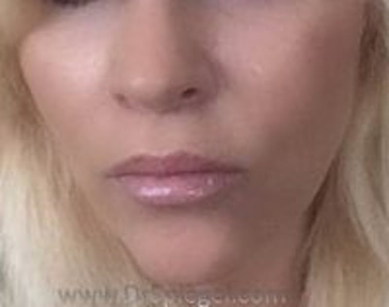 Lip Augmentation / Lip Implant / Lip Lift Before & After Gallery - Patient 157140095 - Image 2