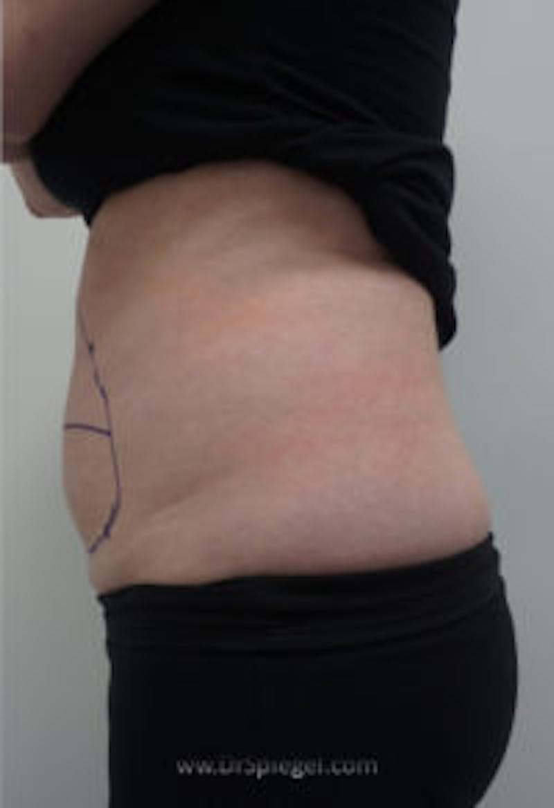 Bodytite Before & After Gallery - Patient 157140101 - Image 3