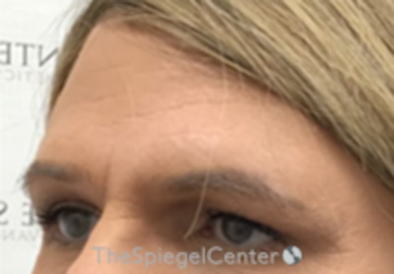 Forehead Contouring Before & After Gallery - Patient 157140097 - Image 1