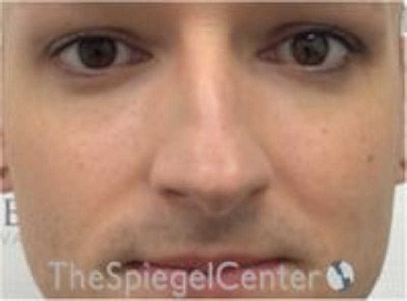Rhinoplasty Before & After Gallery - Patient 157140104 - Image 3