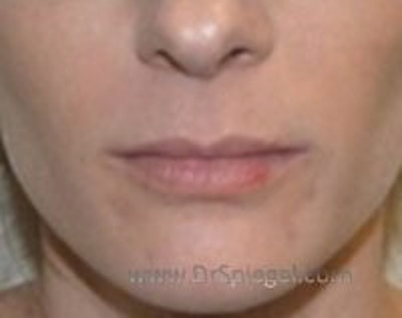 Lip Lift Before & After Gallery - Patient 157140099 - Image 1