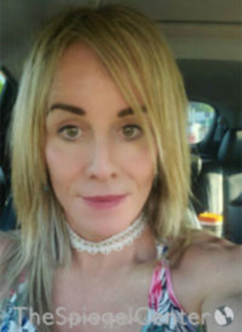 FFS Before & After Gallery - Patient 157140102 - Image 3