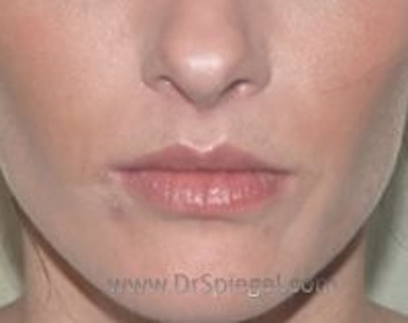 Lip Augmentation / Lip Implant / Lip Lift Before & After Gallery - Patient 157140099 - Image 2