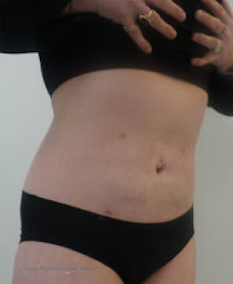 Bodytite Before & After Gallery - Patient 157140101 - Image 6