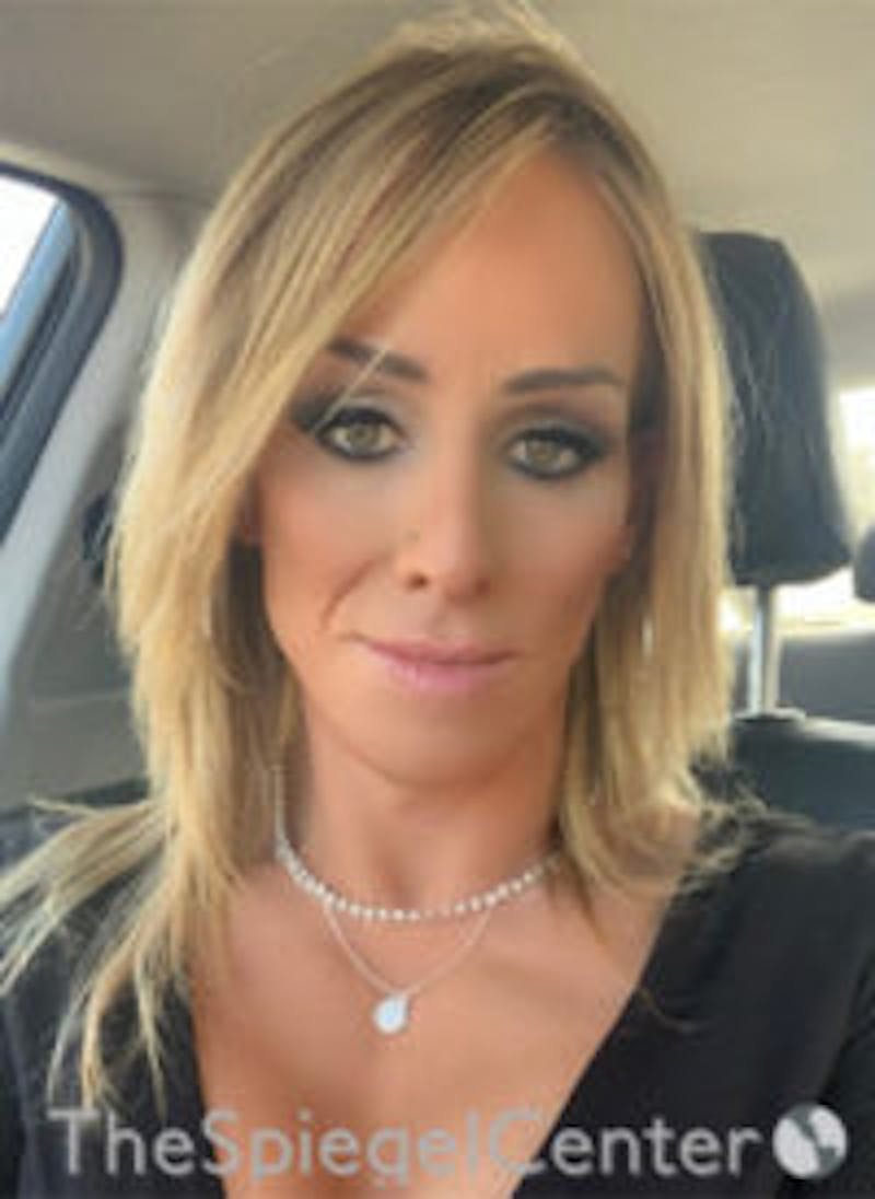 FFS Before & After Gallery - Patient 157140102 - Image 4