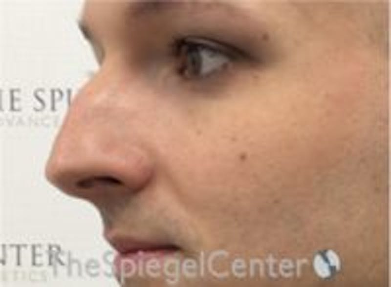 Rhinoplasty Before & After Gallery - Patient 157140104 - Image 1
