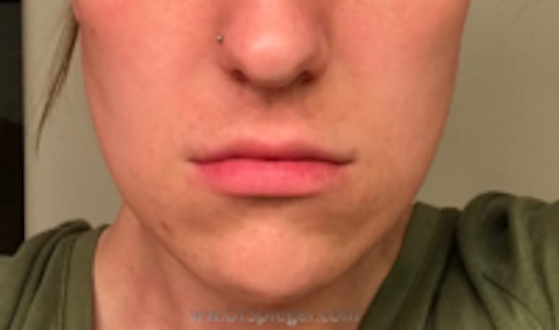 Mandible Contouring Before & After Gallery - Patient 157140106 - Image 1