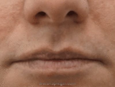Lip Lift Before & After Gallery - Patient 157140108 - Image 1