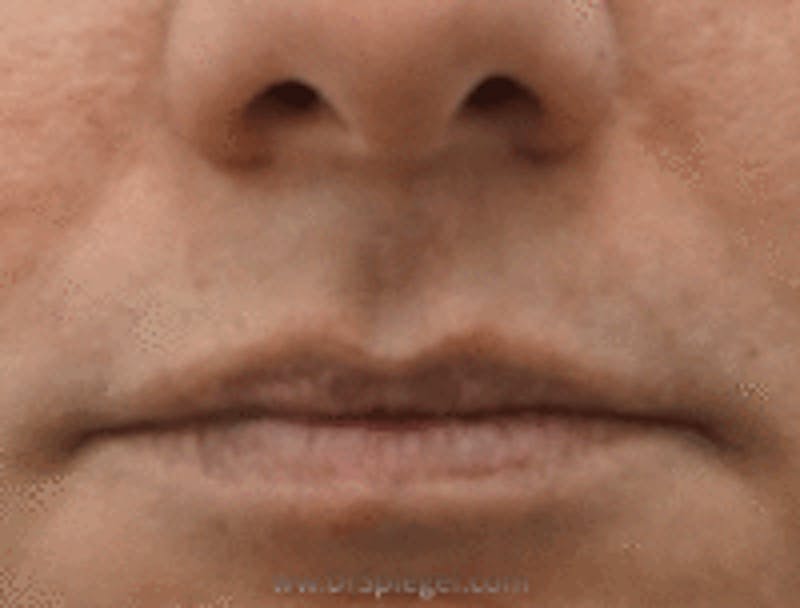 Lip Augmentation / Lip Implant / Lip Lift Before & After Gallery - Patient 157140108 - Image 1