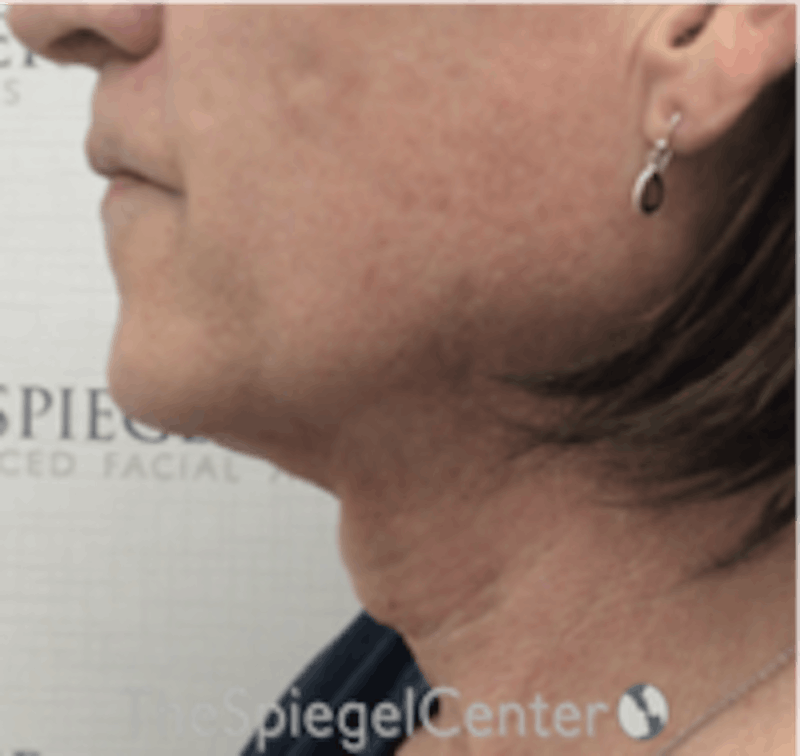 Trachea Shave Before & After Gallery - Patient 157140107 - Image 1