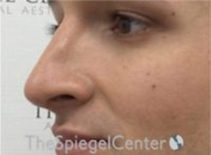 Rhinoplasty Before & After Gallery - Patient 157140104 - Image 2