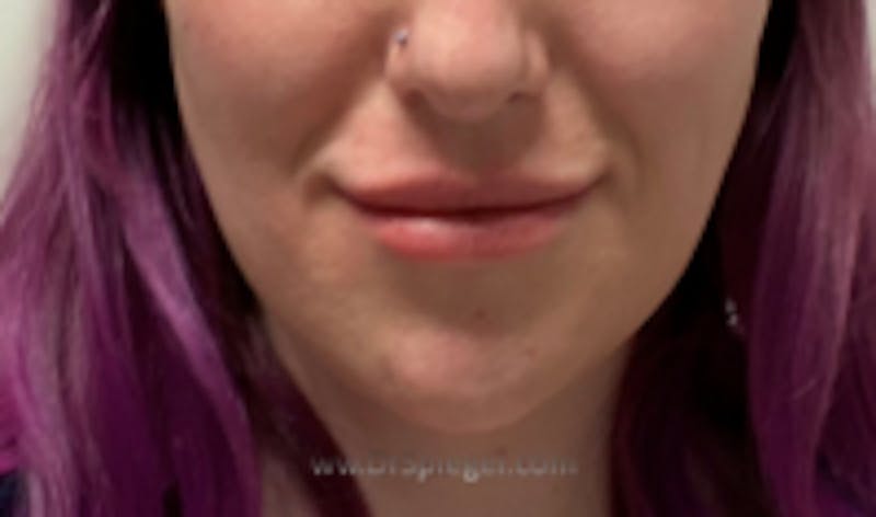 Mandible Contouring Before & After Gallery - Patient 157140106 - Image 2