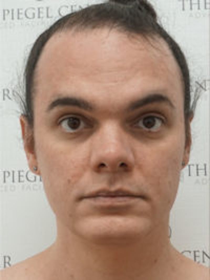 FFS Before & After Gallery - Patient 157140115 - Image 1
