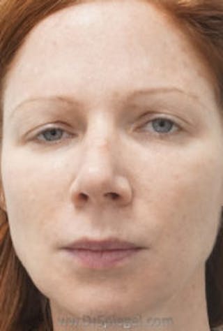 Botox / Dysport / Jeuveau / Xeomin Before & After Gallery - Patient 157140118 - Image 2