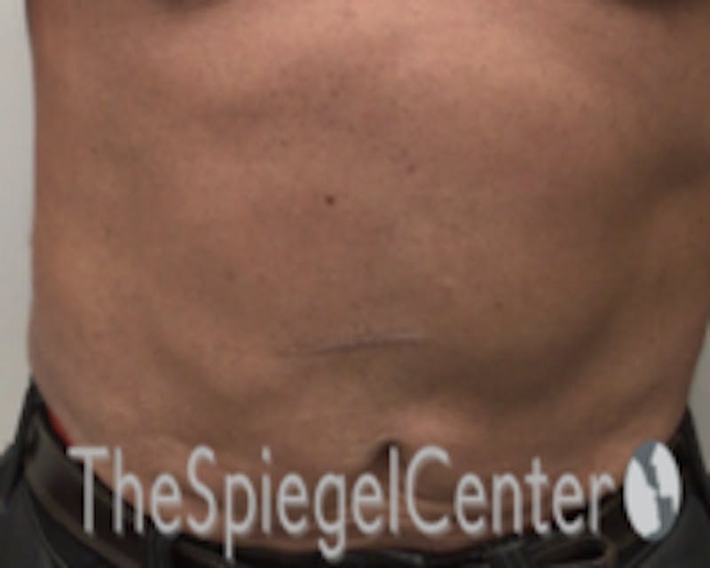 Bodytite Before & After Gallery - Patient 157140120 - Image 2