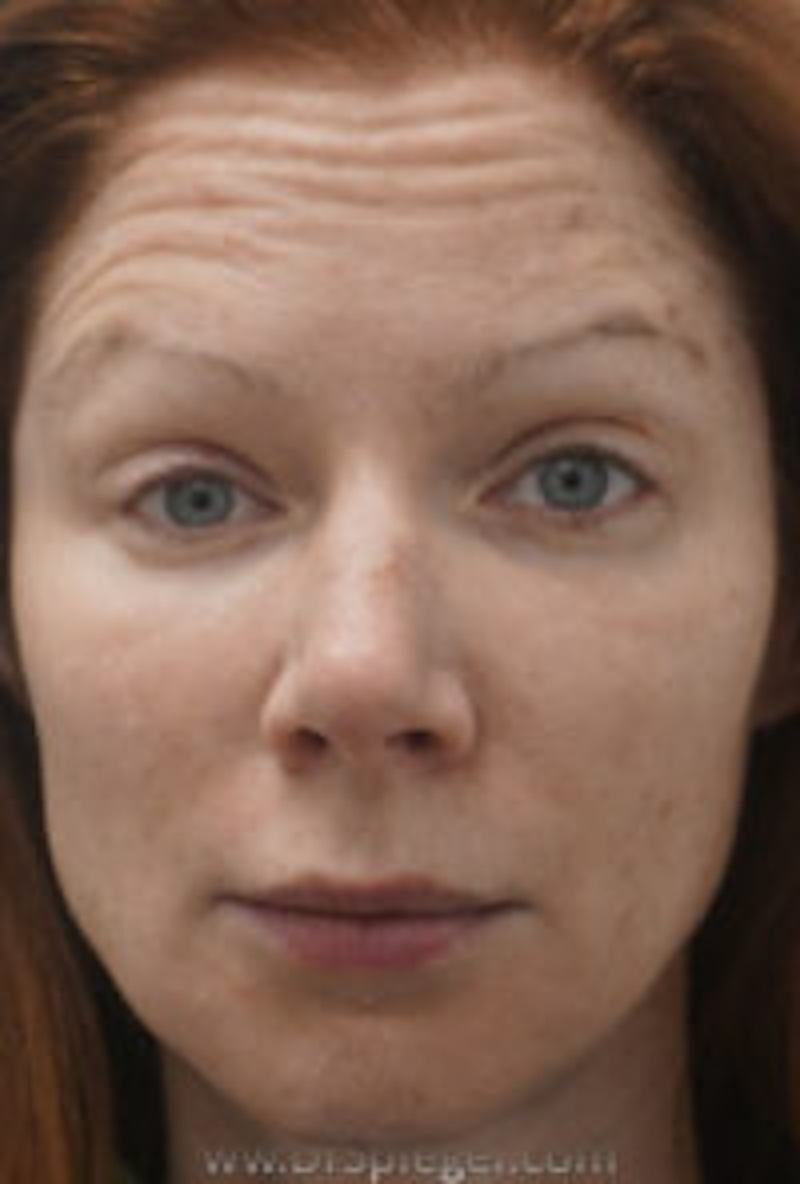 BOTOX in Boston Before and After Photos