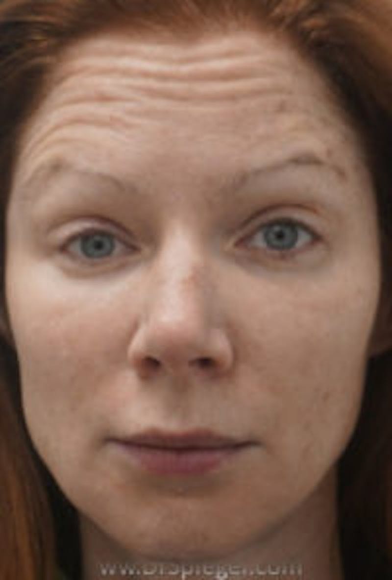 Botox / Dysport / Jeuveau / Xeomin Before & After Gallery - Patient 157140118 - Image 3