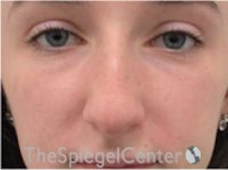 Rhinoplasty Before & After Gallery - Patient 157140116 - Image 3