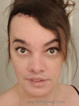 FFS Before & After Gallery - Patient 157140115 - Image 2