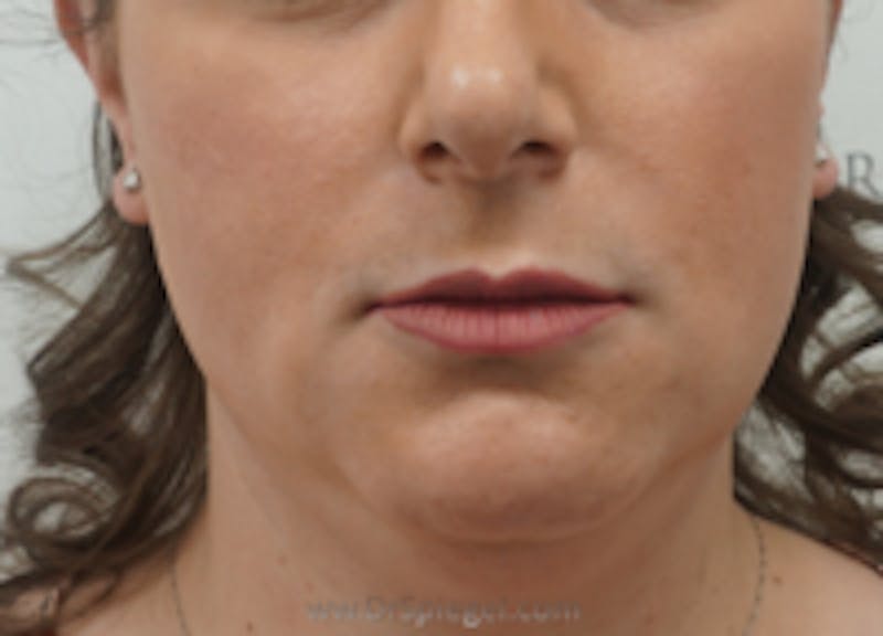 Mandible Contouring Before & After Gallery - Patient 157140112 - Image 1