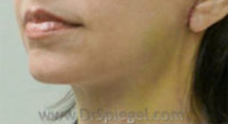 Neck Lift Before & After Gallery - Patient 157140109 - Image 2