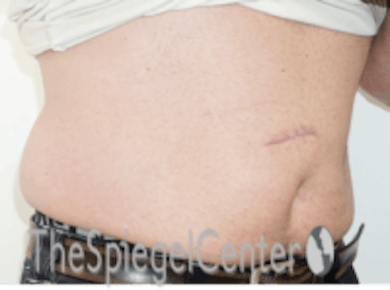 Bodytite Before & After Gallery - Patient 157140120 - Image 3