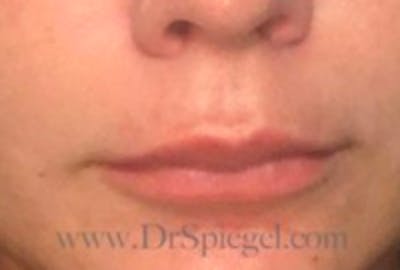Lip Lift Before & After Gallery - Patient 157140113 - Image 1