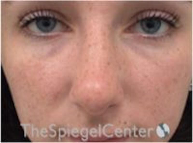 Rhinoplasty Before & After Gallery - Patient 157140116 - Image 4