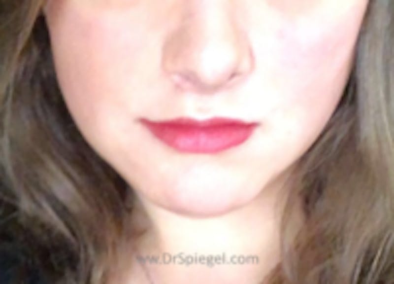 Mandible Contouring Before & After Gallery - Patient 157140112 - Image 2