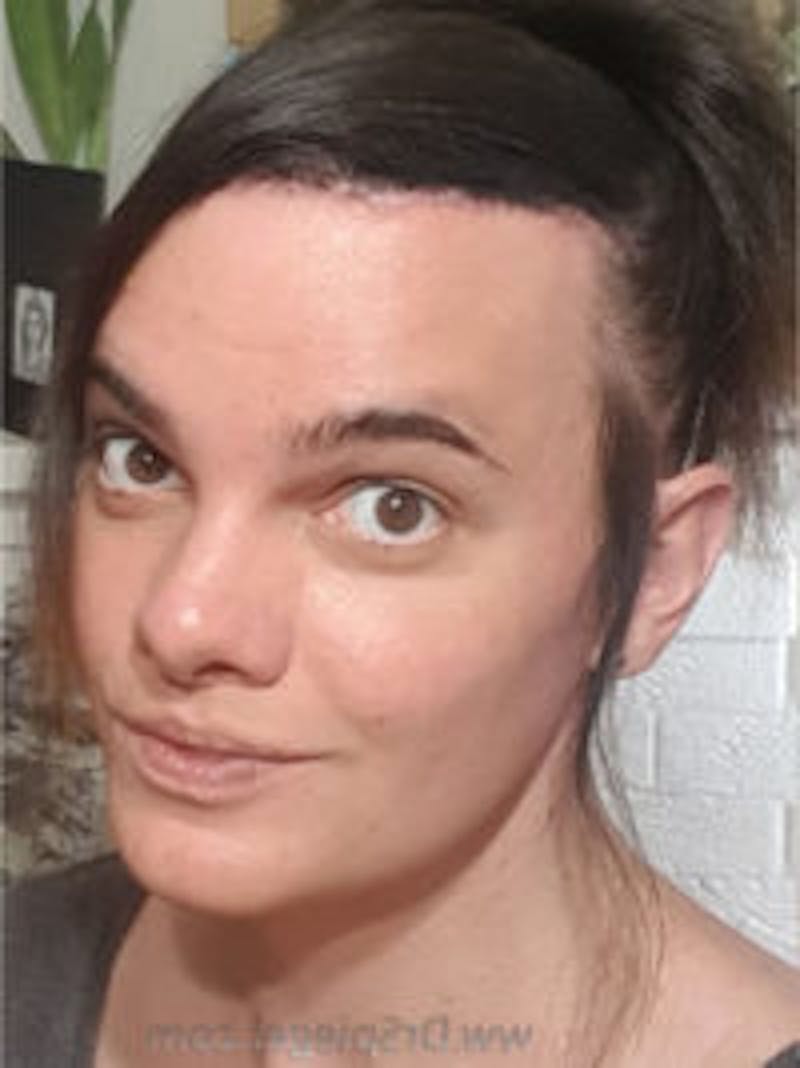 FFS Before & After Gallery - Patient 157140115 - Image 3