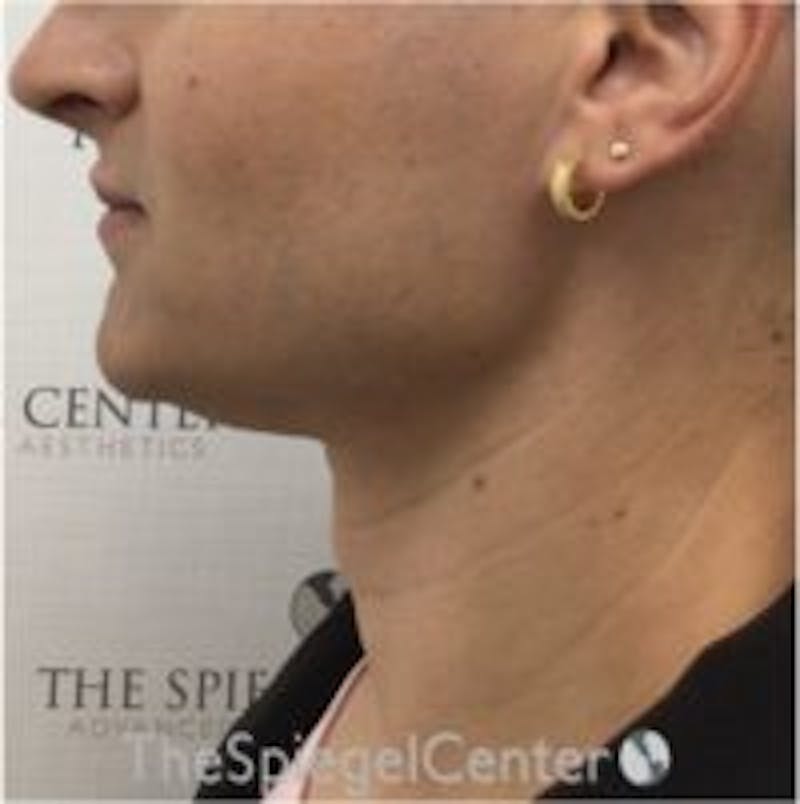 Trachea Shave Before & After Gallery - Patient 157140111 - Image 2