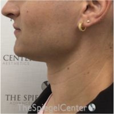 Trachea Shave Before & After Gallery - Patient 157140111 - Image 2