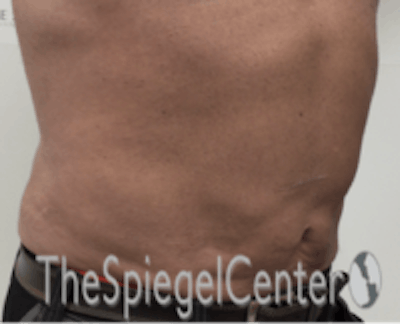 Bodytite Before & After Gallery - Patient 157140120 - Image 4